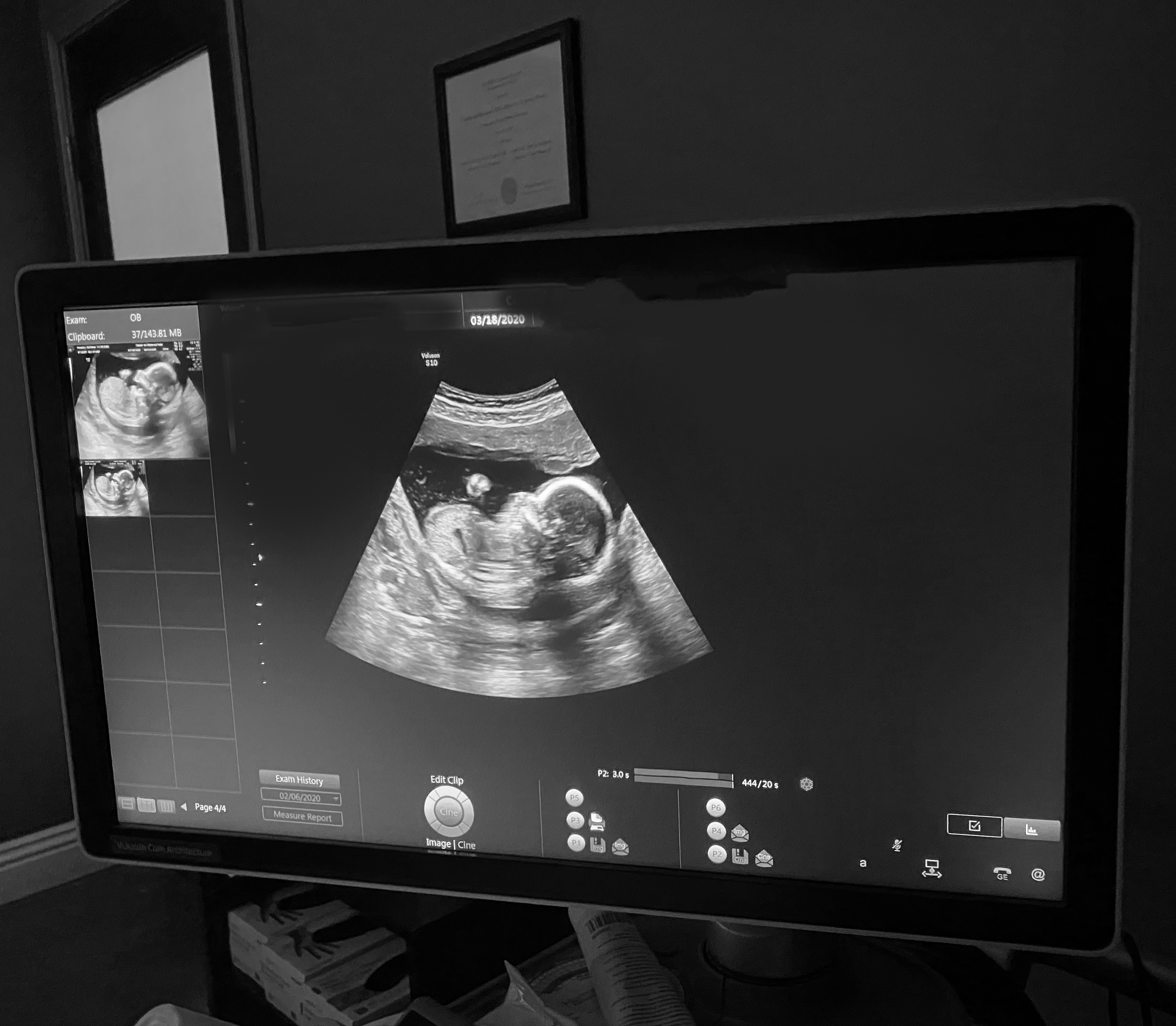 baby ultrasound 18 weeks